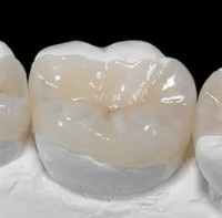 セラミックインレー