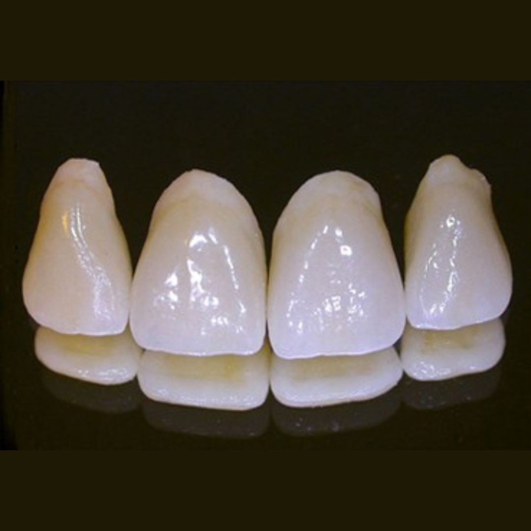 ジルコニア冠(グラデーション)